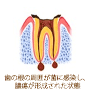歯の根の周囲が菌に感染した状態のイラスト