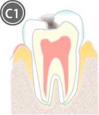 エナメル質内の虫歯のイラスト