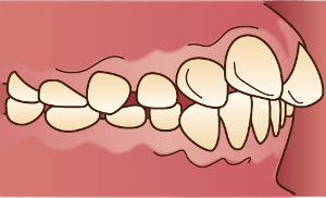 出っ歯（上顎前突）のイラスト | 八王子駅前の対話を大切にする歯医者｜くろさわ歯科医院