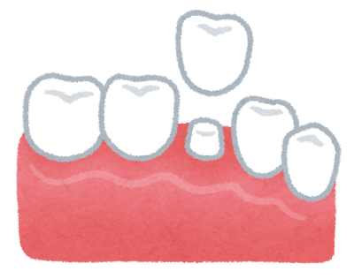 被せ物の写真